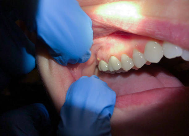 Best Emergency Dental Care for Broken or Chipped Teeth in Crescent Springs, KY